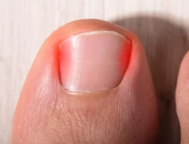 Νύχι που μπαίνει στο δέρμα: Τα σωστά βήματα αντιμετώπισης